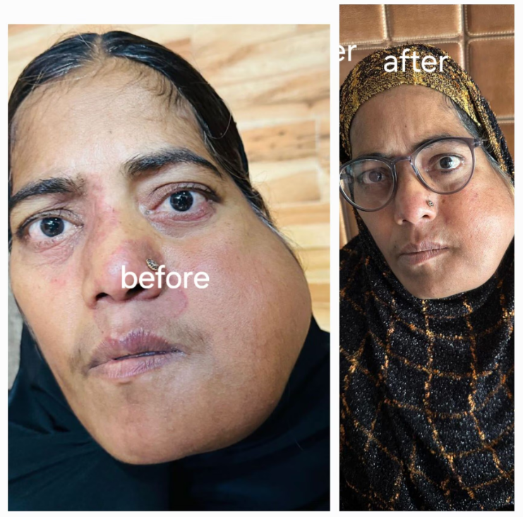 Before and after treatment for chronic dermatitis and repigmentation